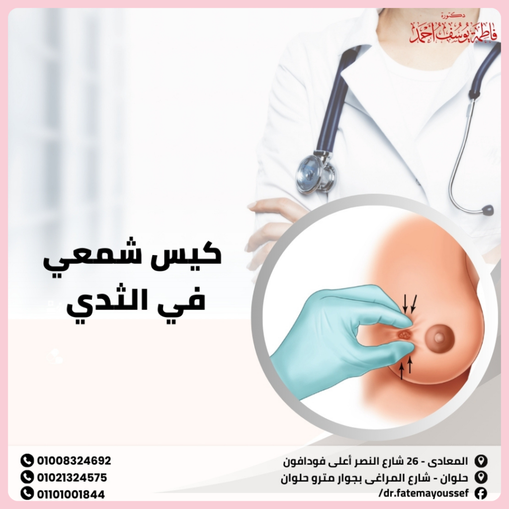 كيس شمعي في الثدي