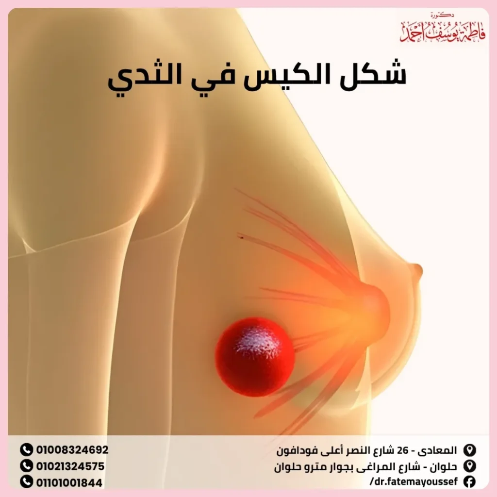 شكل الكيس في الثدي