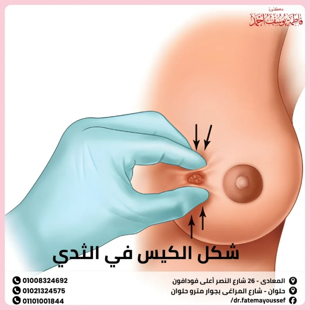 شكل الكيس في الثدي