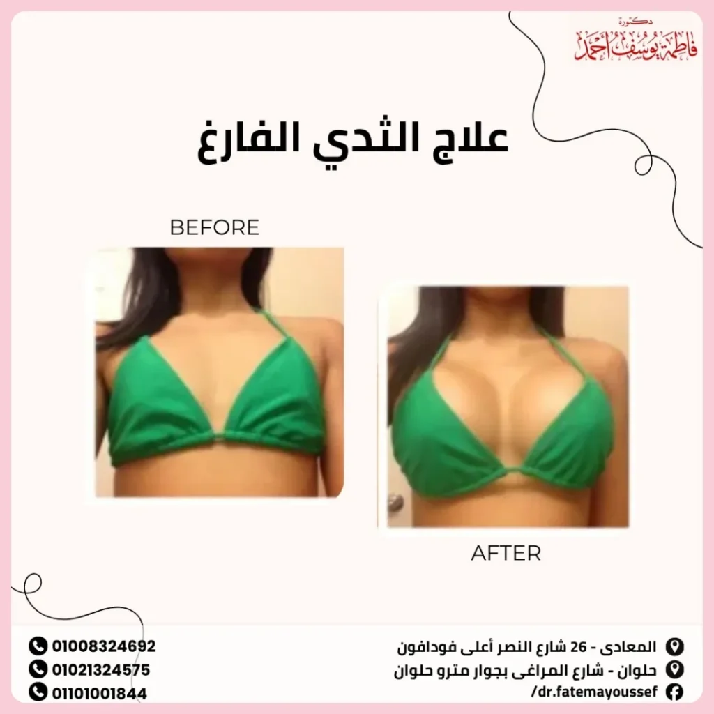 علاج الثدي الفارغ