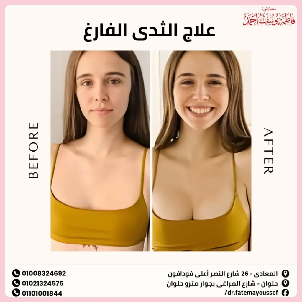 علاج الثدي الفارغ