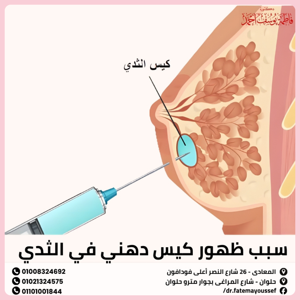 سبب ظهور كيس دهني في الثدي