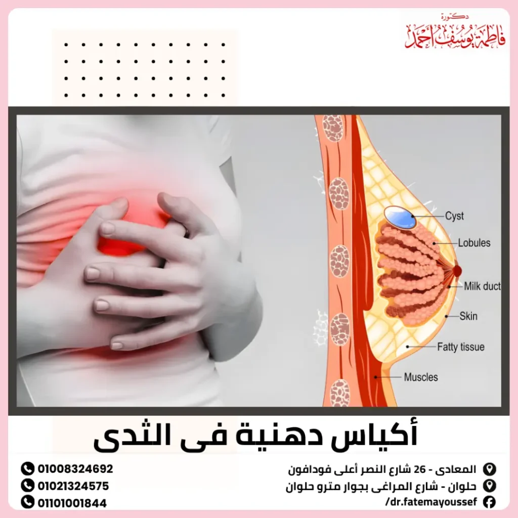 اكياس دهنية في الثدي