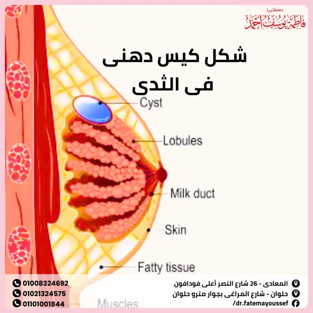 شكل كيس دهني في الثدي