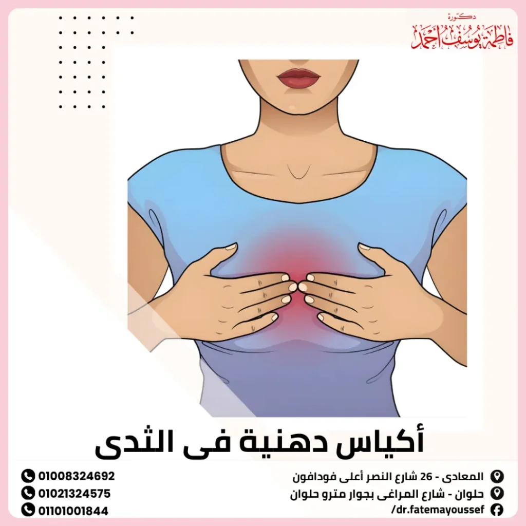 اكياس دهنية في الثدي
