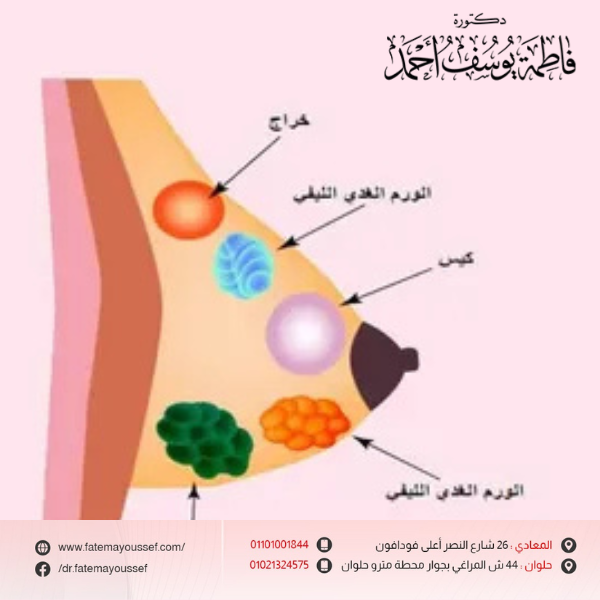 تجربتي مع أكياس الثدي المائية