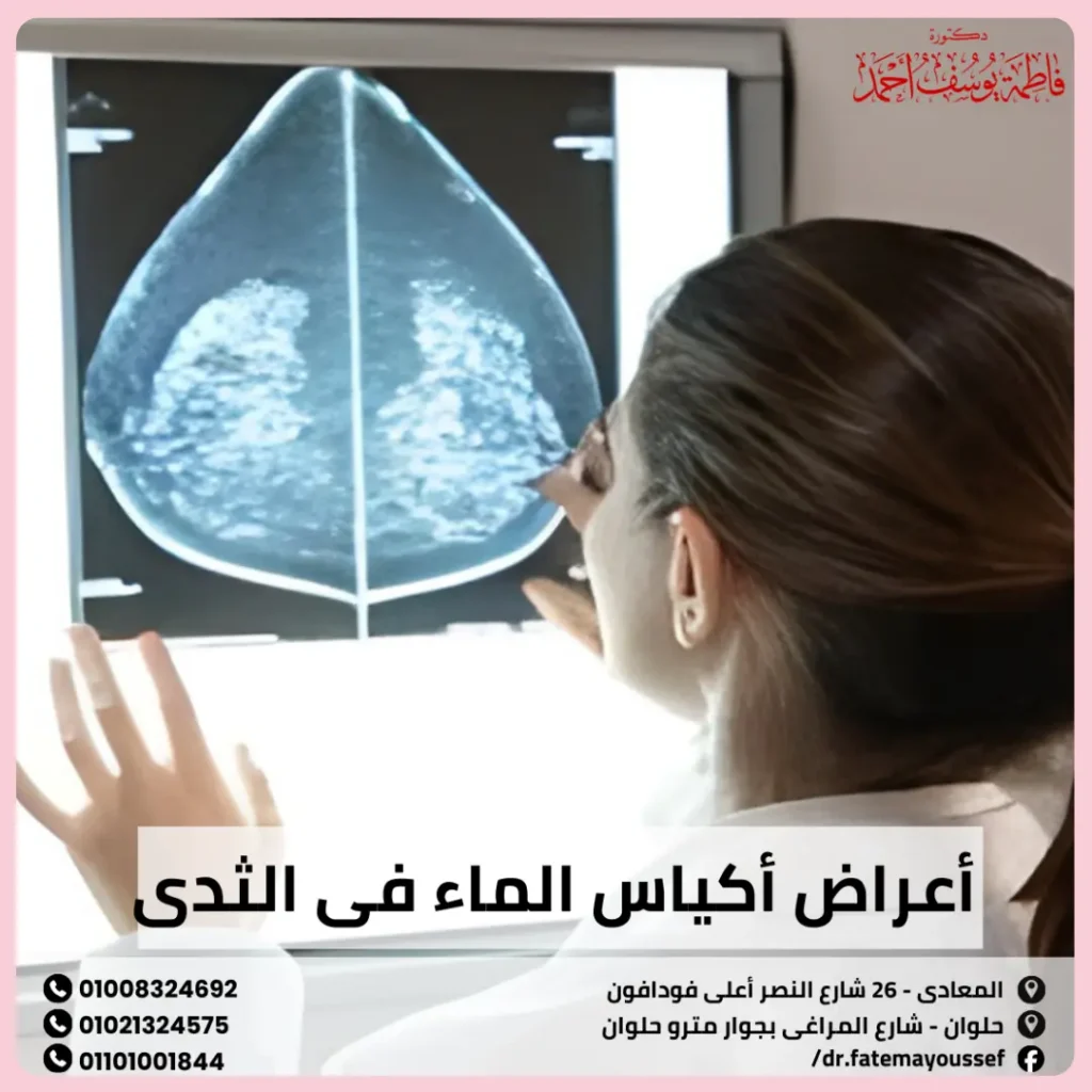 أعراض أكياس الماء في الثدي