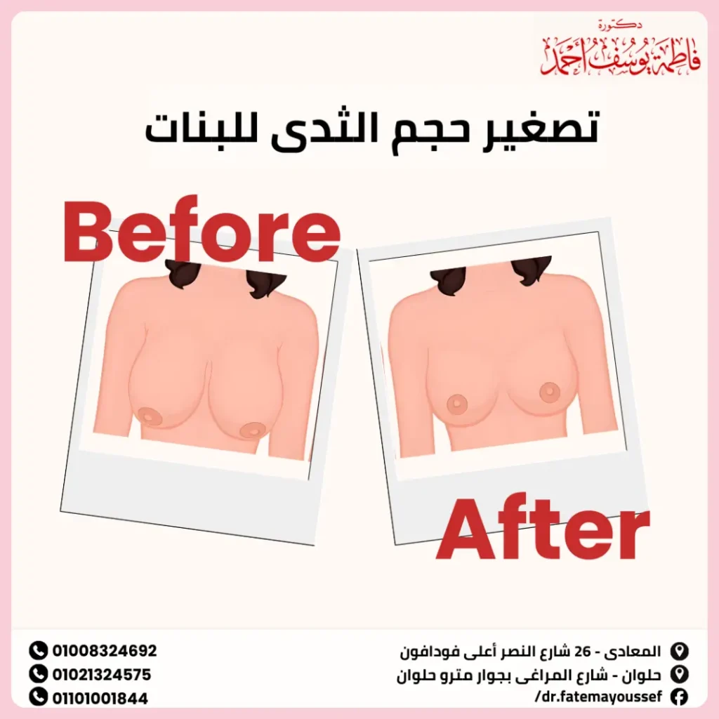 تصغير حجم الثدي للبنات