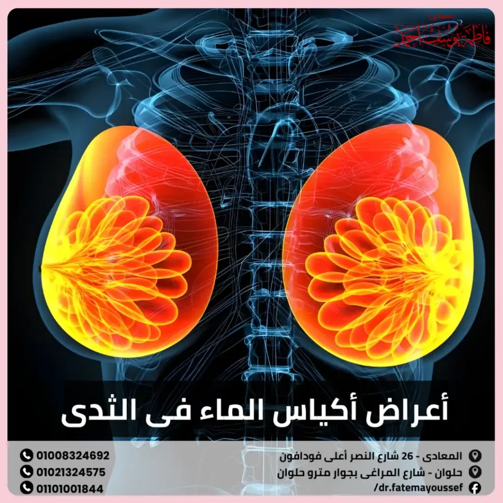أعراض أكياس الماء في الثدي