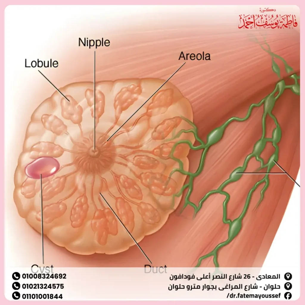 كيس هرموني في الثدي
