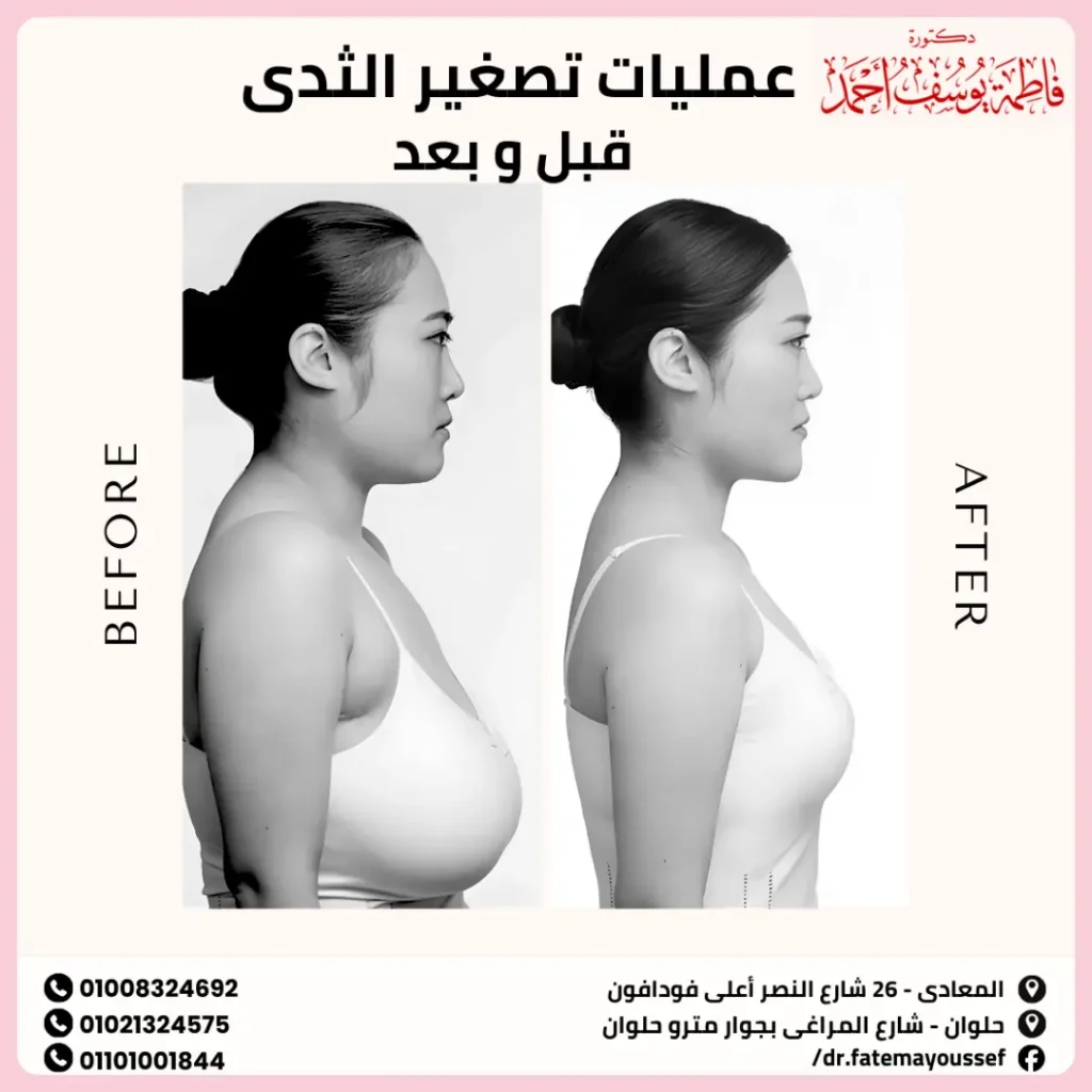 عمليات تصغير الثدي قبل وبعد