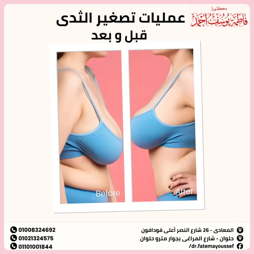 عمليات تصغير الثدي قبل وبعد