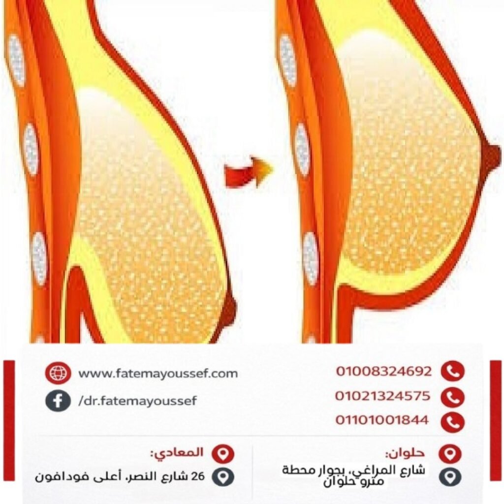 أدوية لعلاج ترهل الثدي