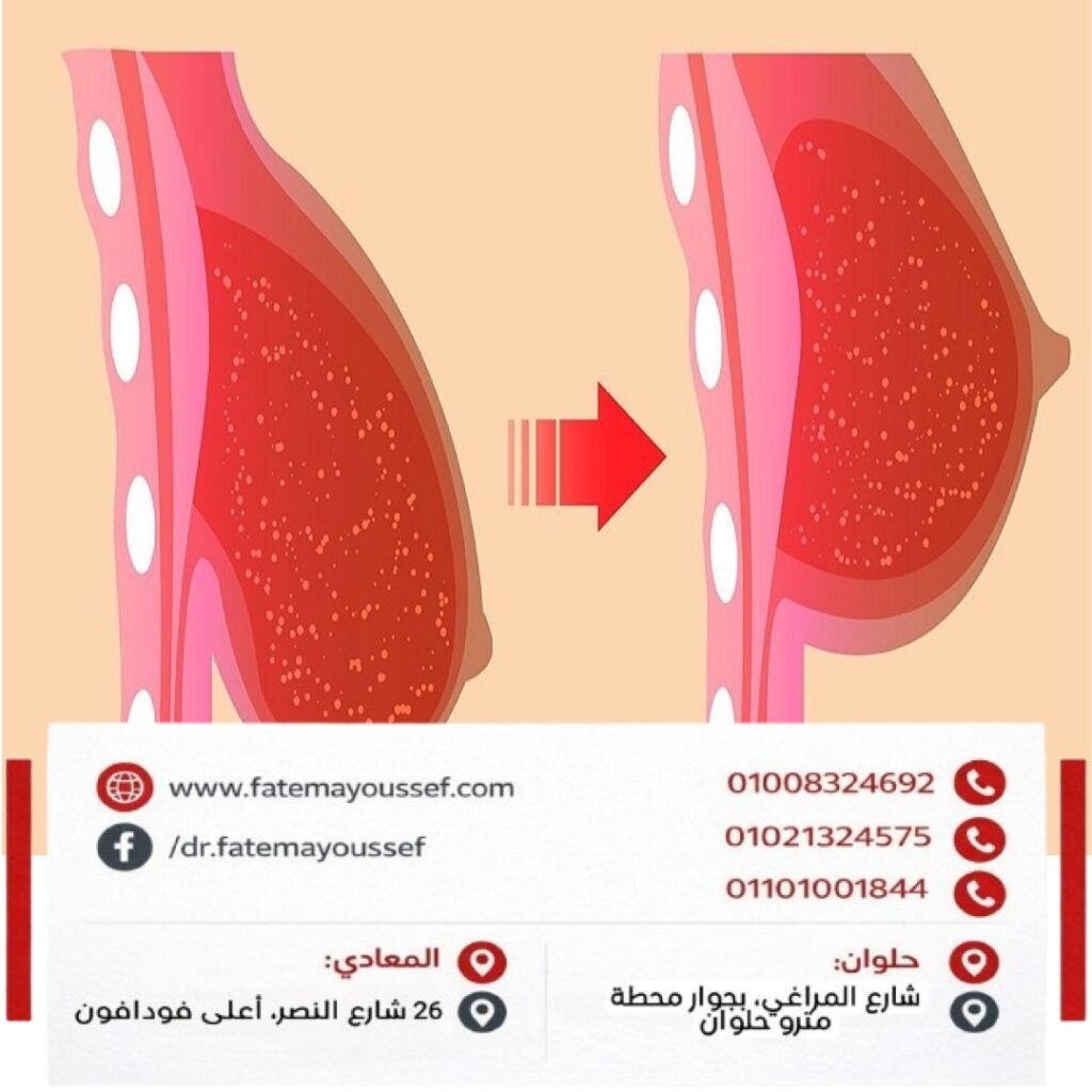 أدوية لعلاج ترهل الثدي