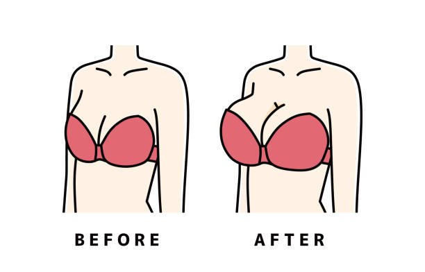 عمليات تصغير الثدي قبل وبعد