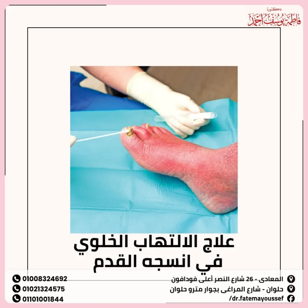 علاج الالتهاب الخلوي في انسجه القدم