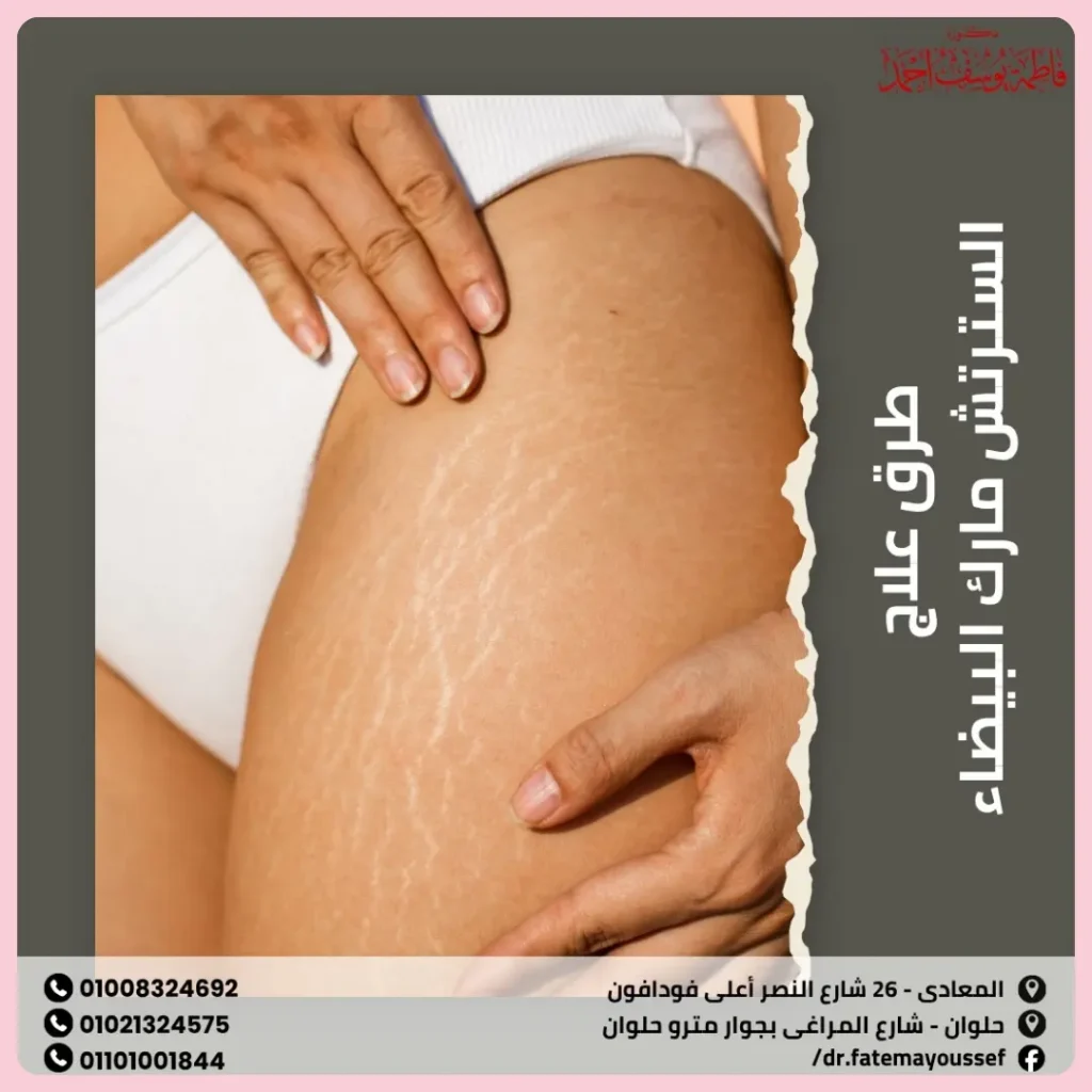 طرق علاج السترتش مارك البيضاء