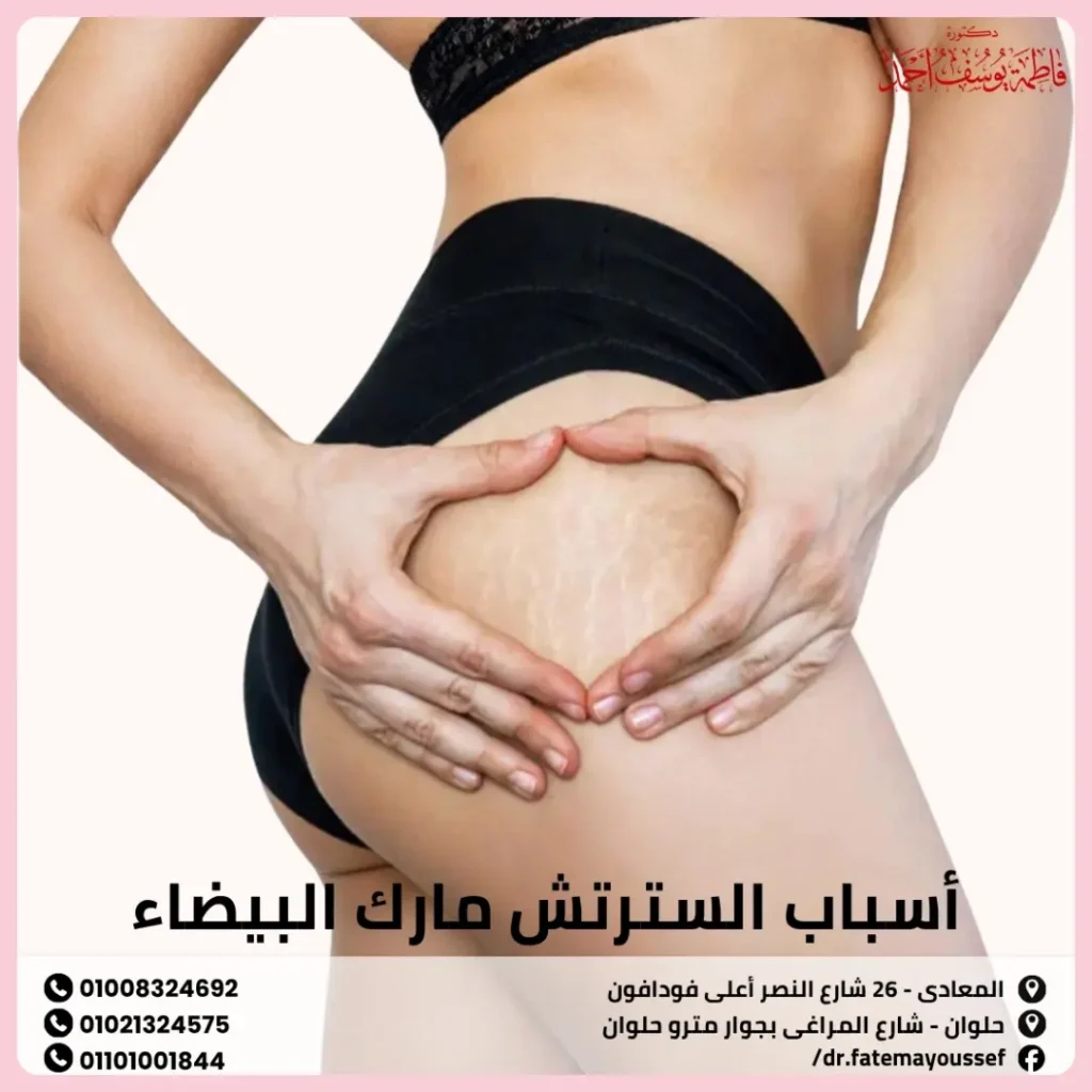 ازالة السترتش مارك البيضاء