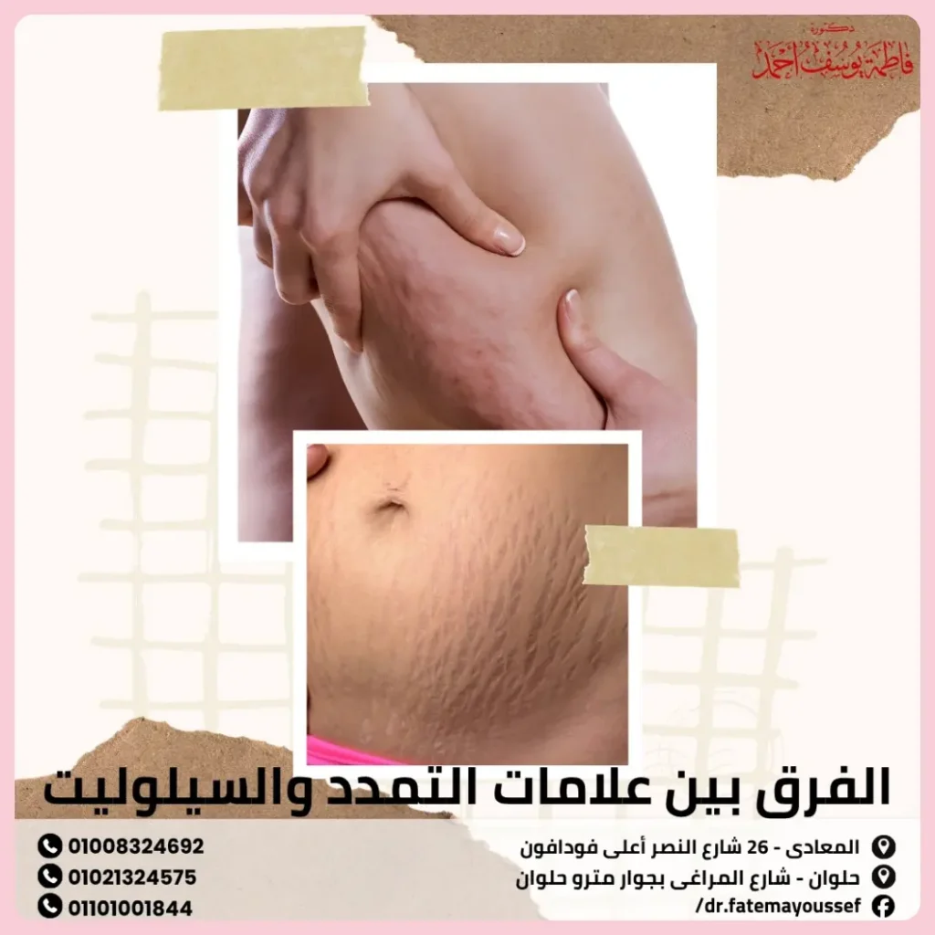 الفرق بين علامات التمدد والسيلوليت
