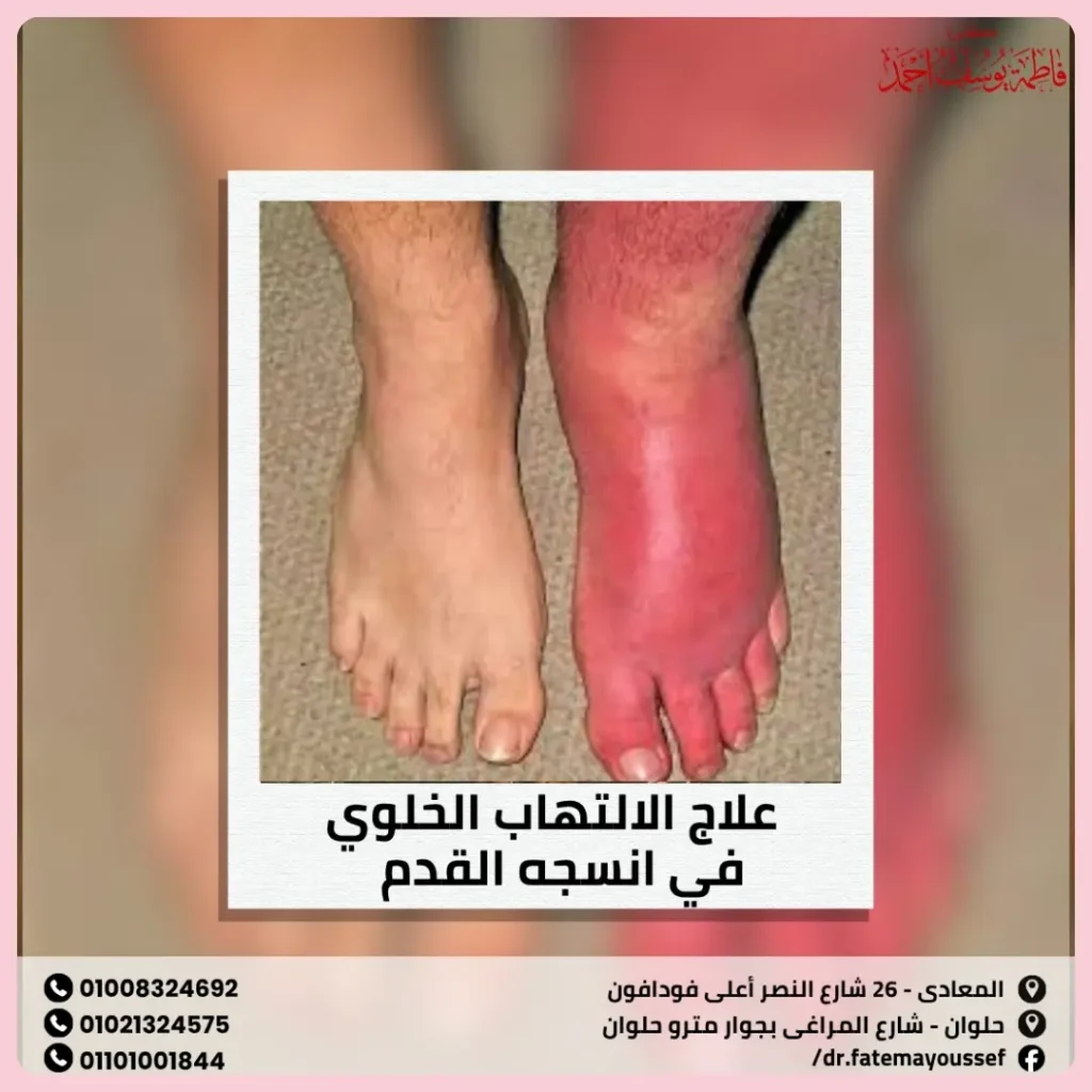 علاج الالتهاب الخلوي في انسجه القدم