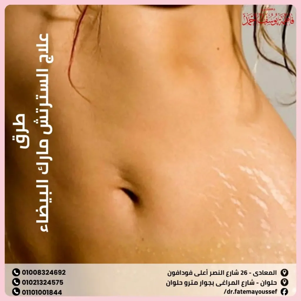 طرق علاج السترتش مارك البيضاء