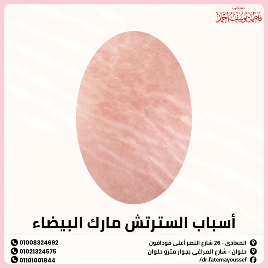 ازالة السترتش مارك البيضاء