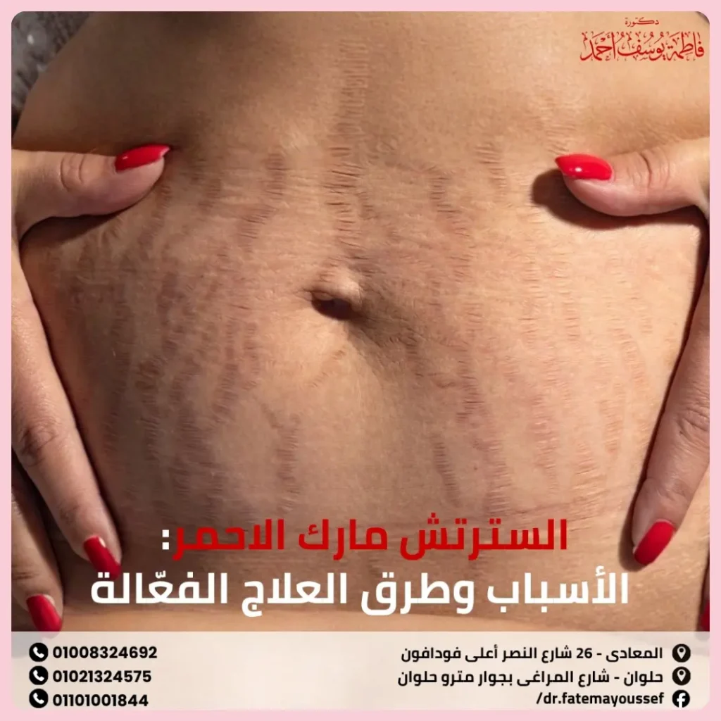 السترتش مارك الاحمر
