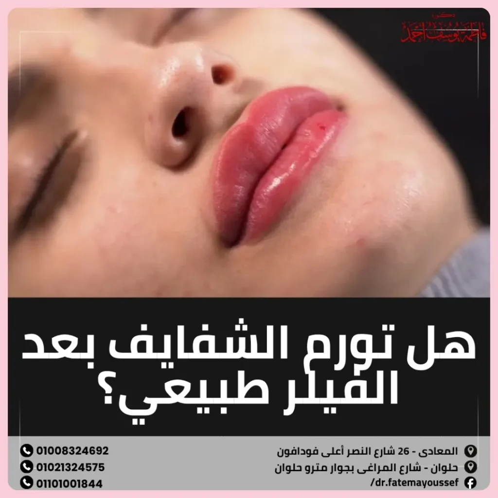 هل تورم الشفايف بعد الفيلر طبيعي
