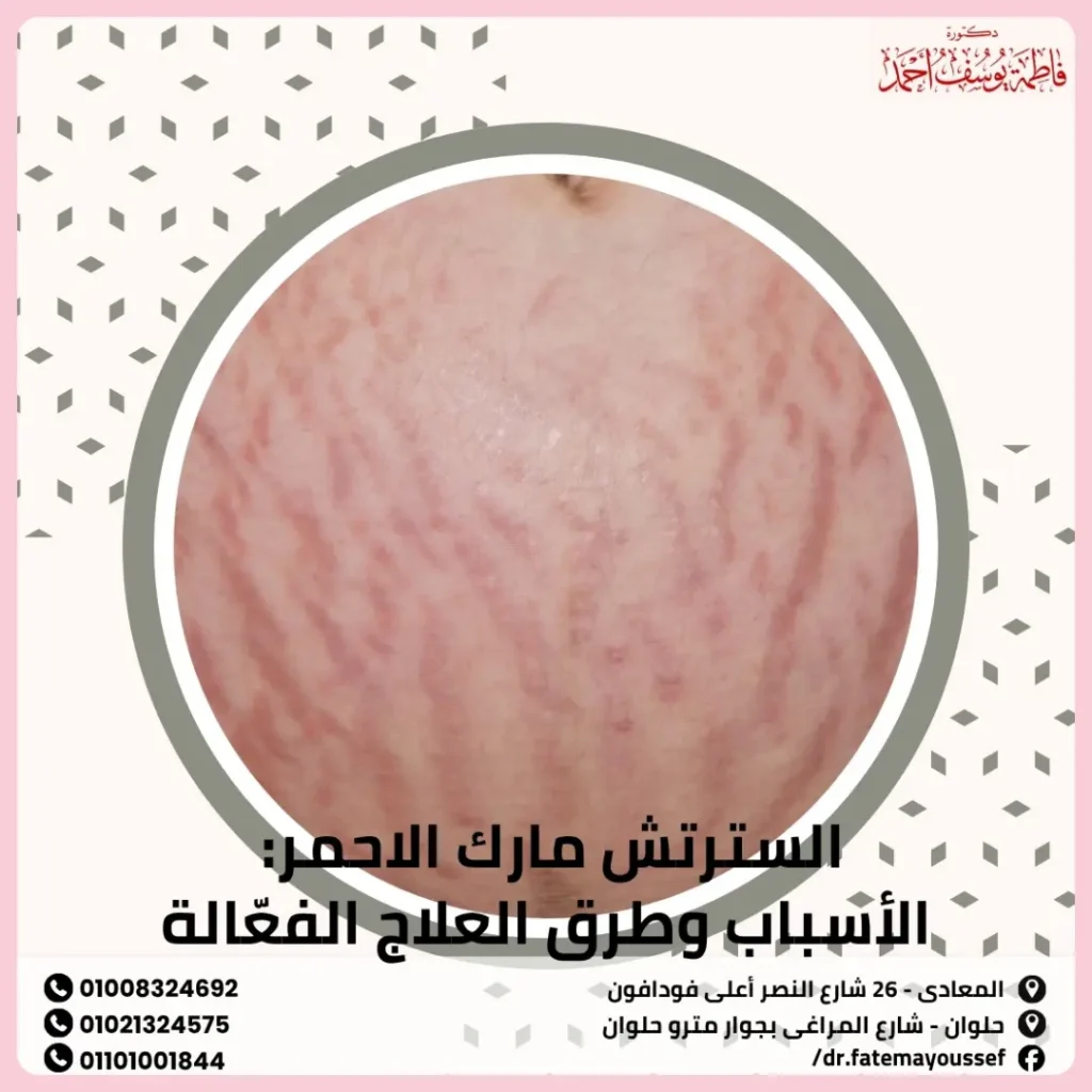 السترتش مارك الاحمر