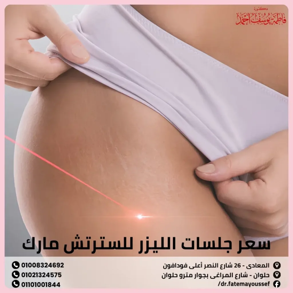سعر جلسات الليزر للسترتش مارك