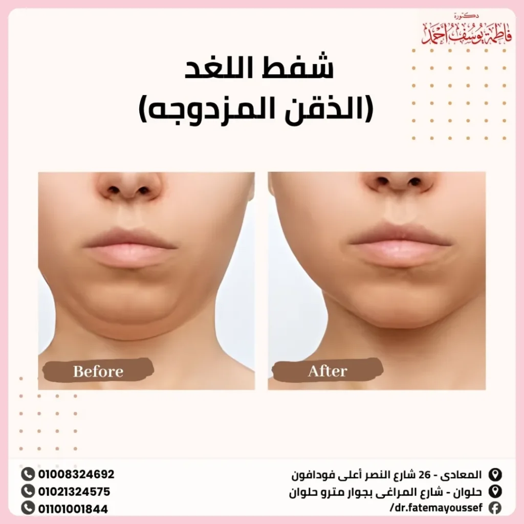 شفط اللغد (الذقن المزدوجه)