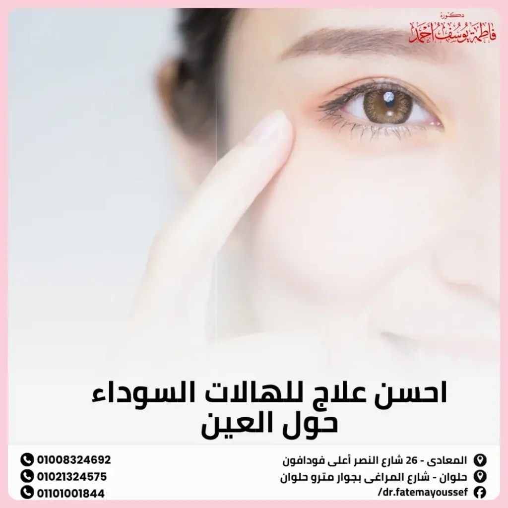 احسن علاج للهالات السوداء حول العين