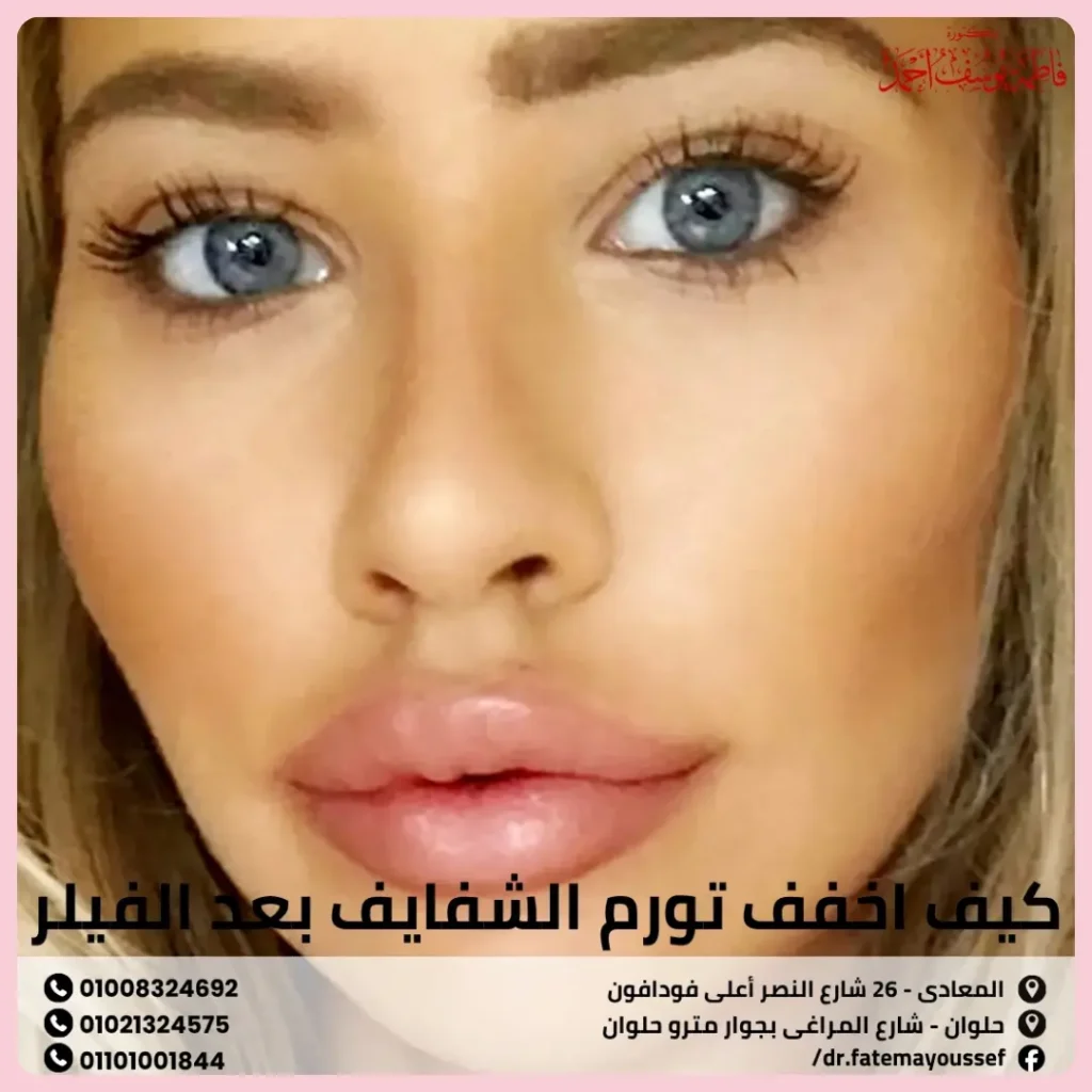 كيف اخفف تورم الشفايف بعد الفيلر