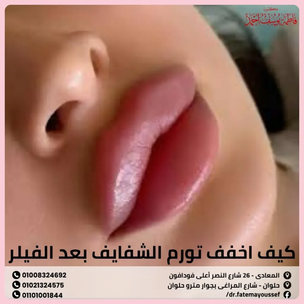 كيف اخفف تورم الشفايف بعد الفيلر