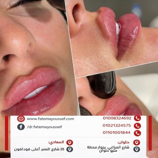 متى اعمل مساج بعد فيلر الشفايف