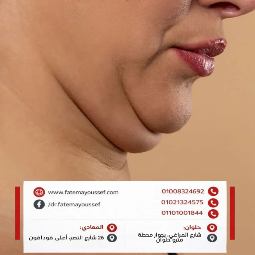 شفط اللغد (الذقن المزدوجه)