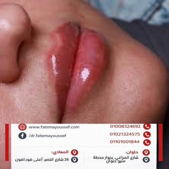 فيلر نص سيسي