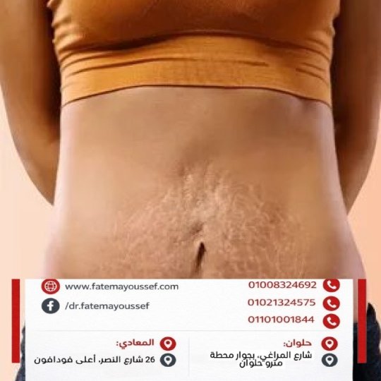 ازالة السترتش مارك البيضاء