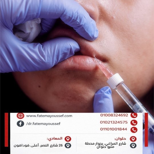 متى اقدر أكل بعد فيلر الشفايف