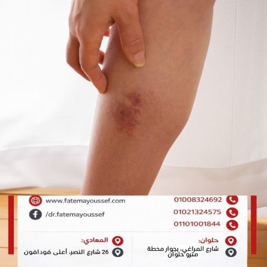 علاج الالتهاب الخلوي في انسجه القدم