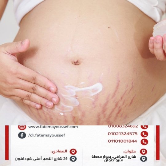 طرق علاج السترتش مارك البيضاء