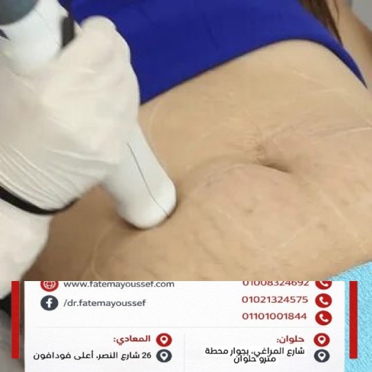 سعر جلسات الليزر للسترتش مارك