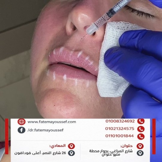 هل الفيلر مضر للشفايف