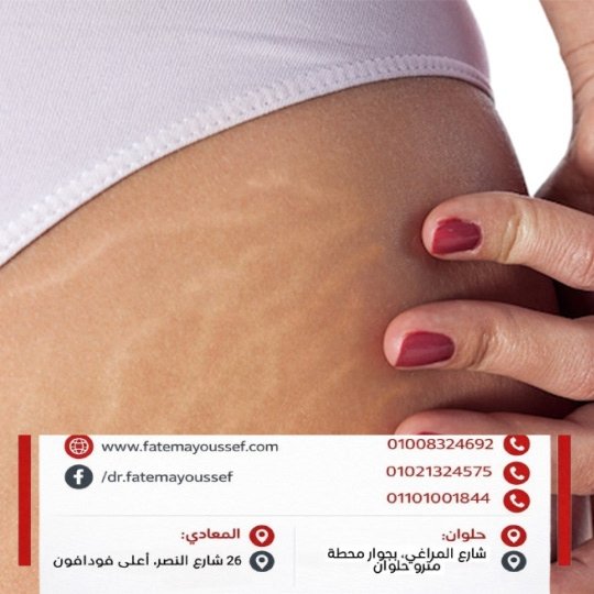 الفرق بين علامات التمدد والسيلوليت