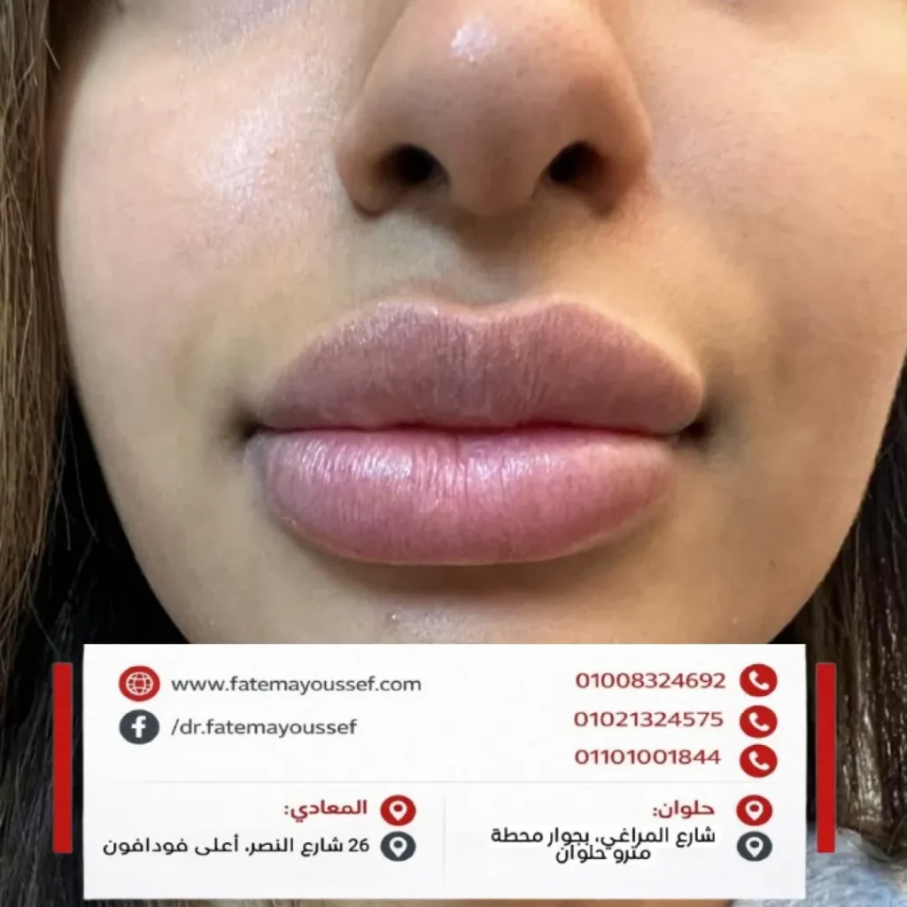 هل تورم الشفايف بعد الفيلر طبيعي