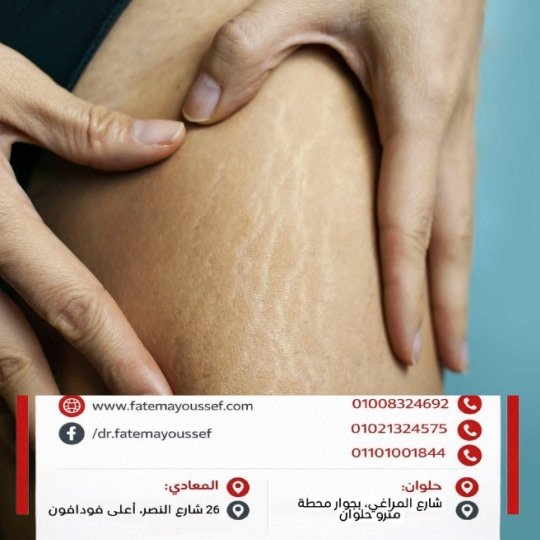 الفرق بين علامات التمدد والسيلوليت