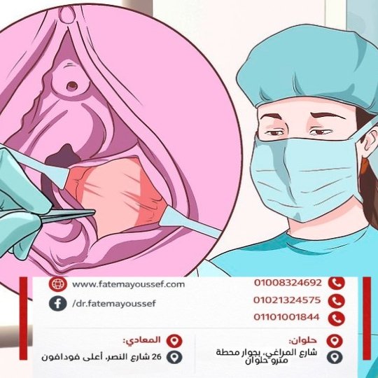 تجعد الشفرات الخارجية