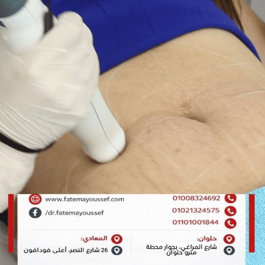 ازالة السترتش مارك البيضاء