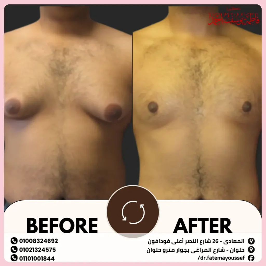 عمليات التثدي للرجال