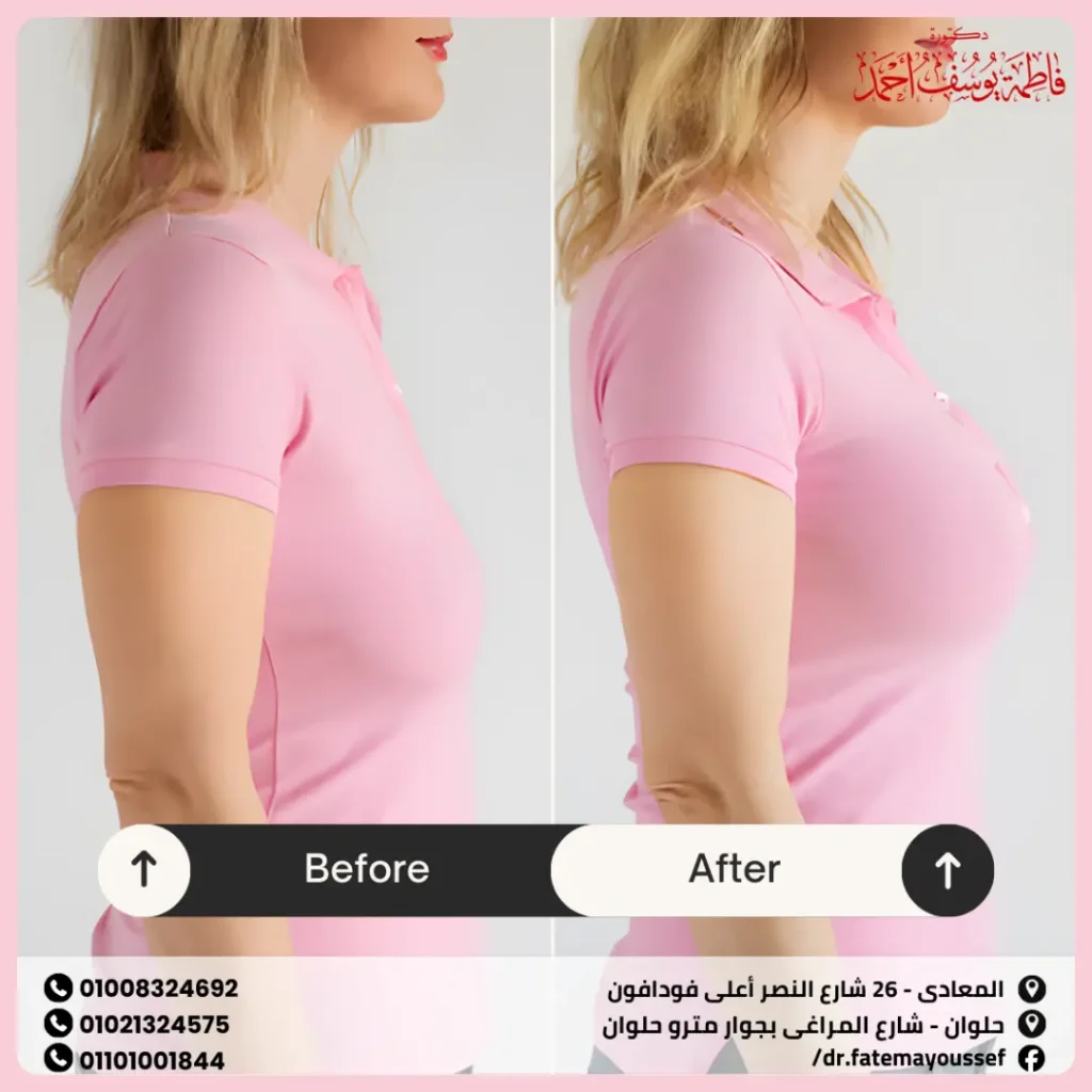 تجارب ناجحة لتكبير الثدي